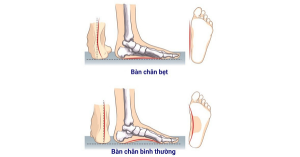 Hội chứng bàn chân bẹt là gì?