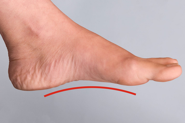 Hội chứng bàn chân bẹt có gây nguy hiểm không?